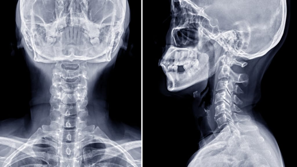 Cervical Disc Herniation