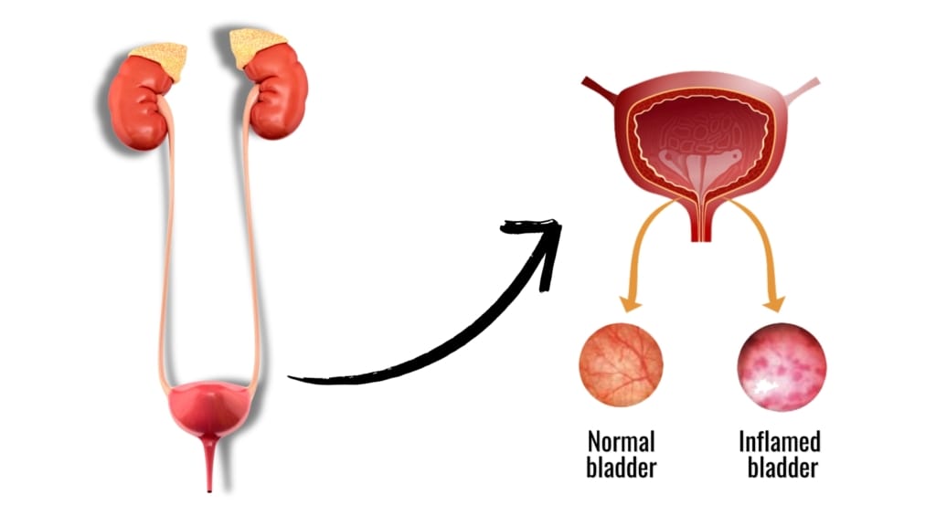 What causes bladder inflammation