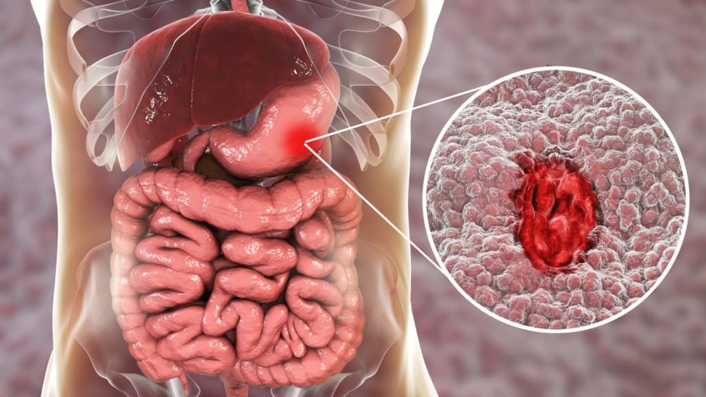 Inflammation of the stomach