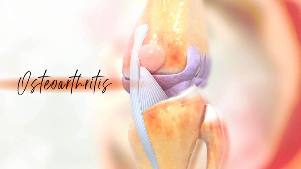 Osteoarthritis