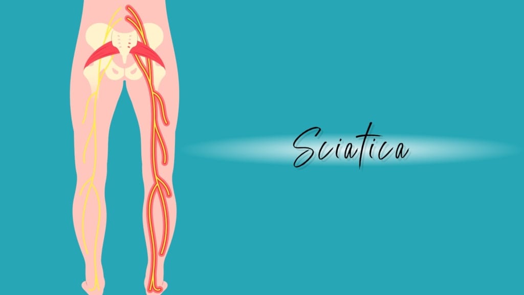 Sciatica