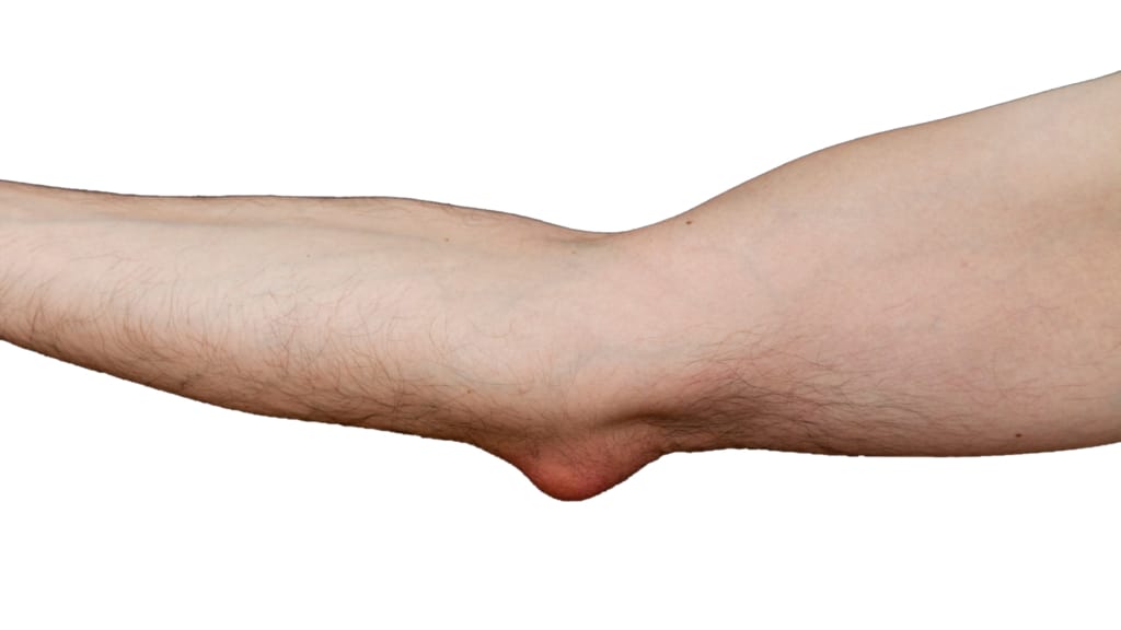 Symptoms of Elbow Bursitis