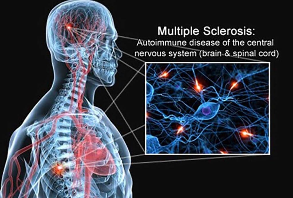 MS and ANF Therapy