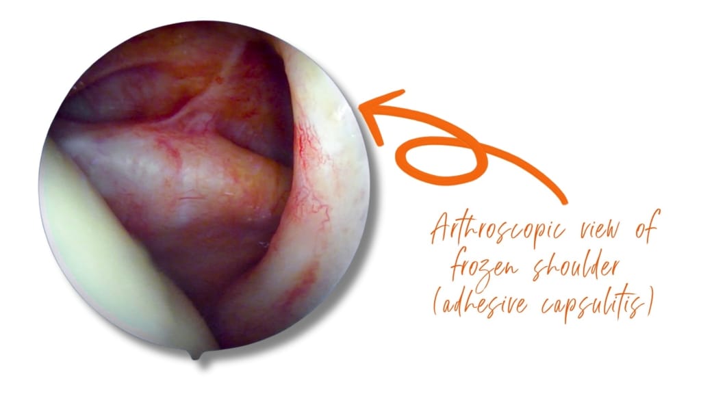 Shoulder capsule - frozen shoulder