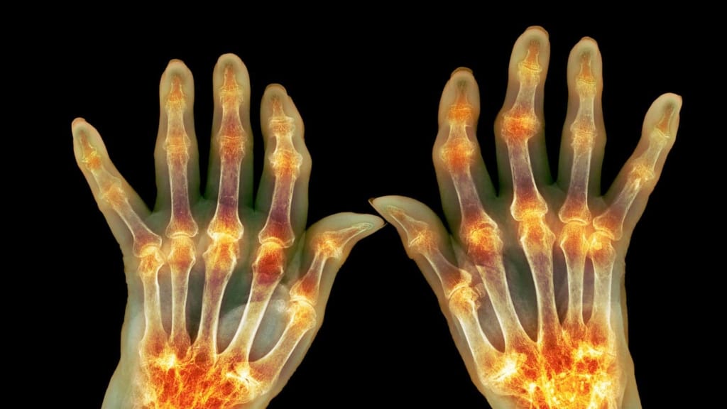 Types of Rheumatoid Arthritis