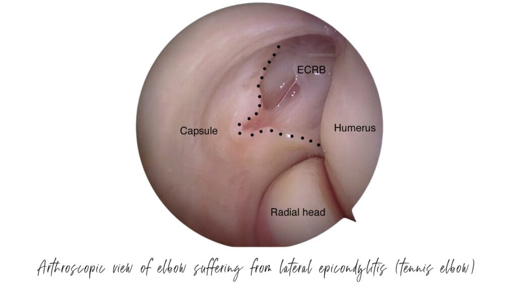 Anatomy lateral epicondylitis