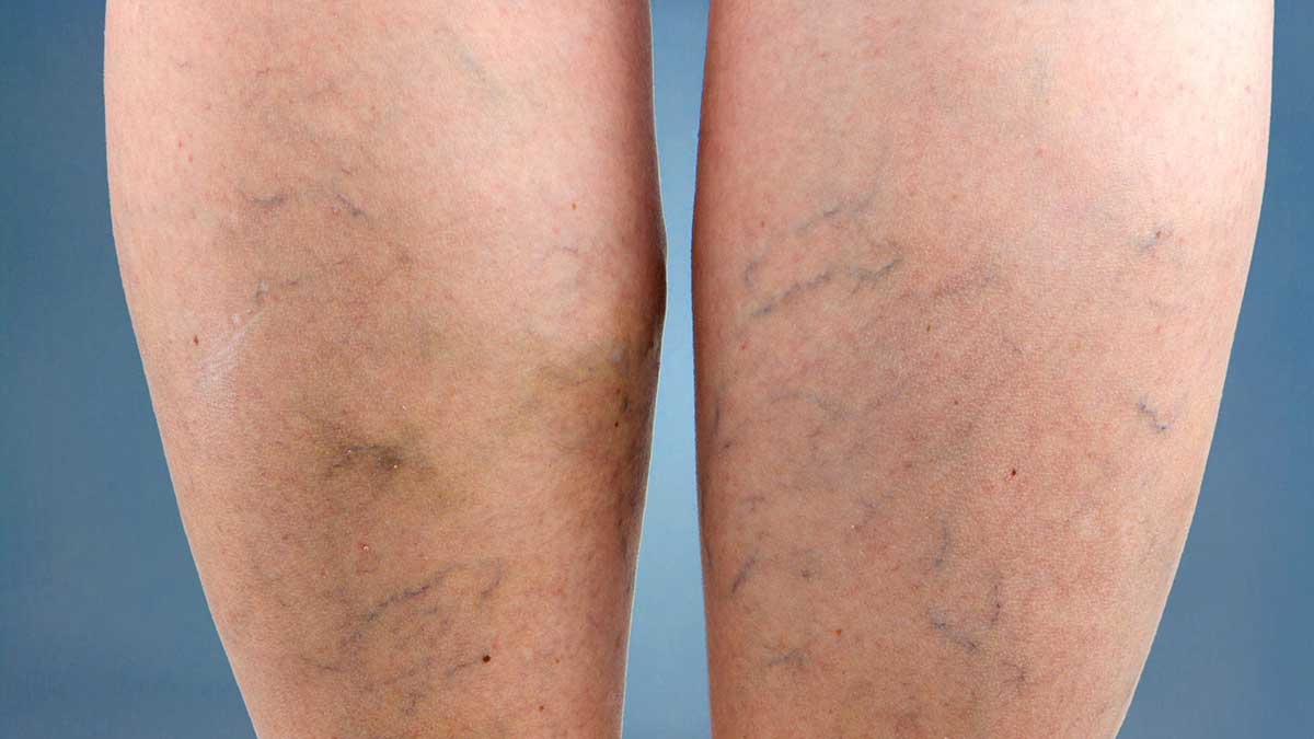 Signs And Symptoms Of Varicose Veins