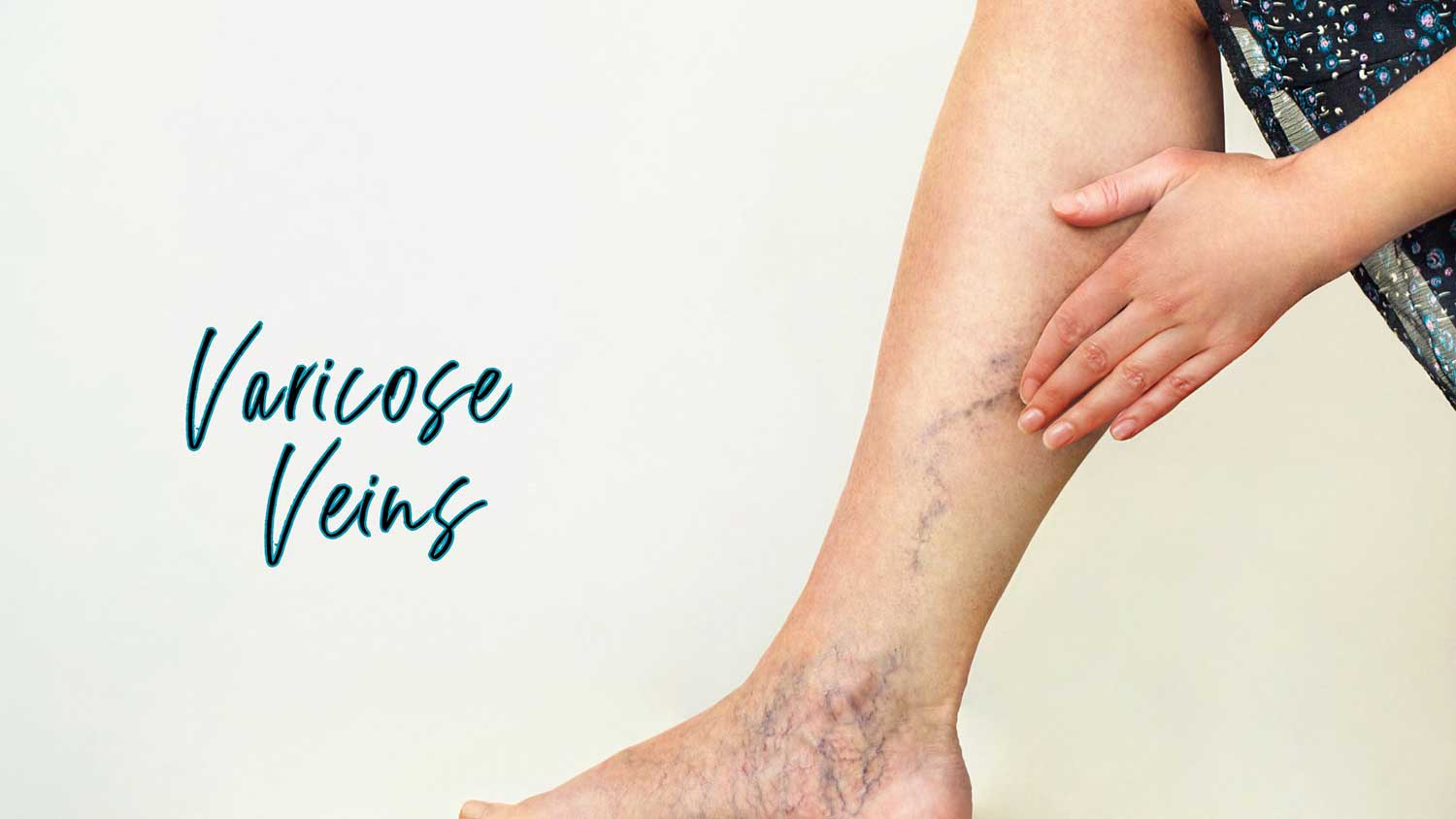 Varicose Veins