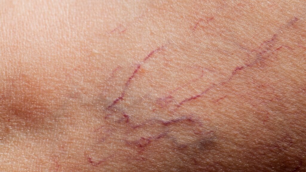 Varicose Veins closeup