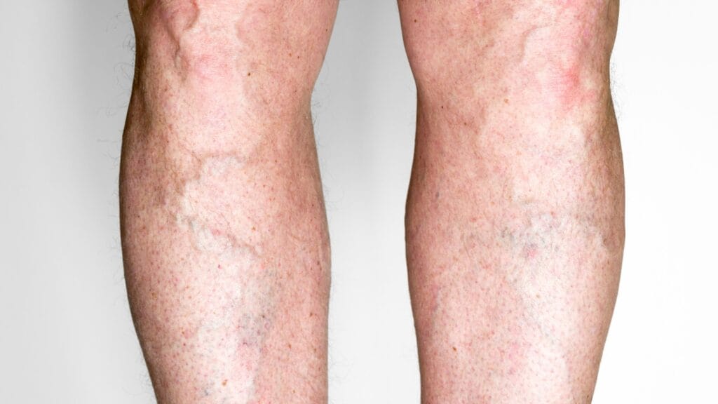 Varicose Veins on legs