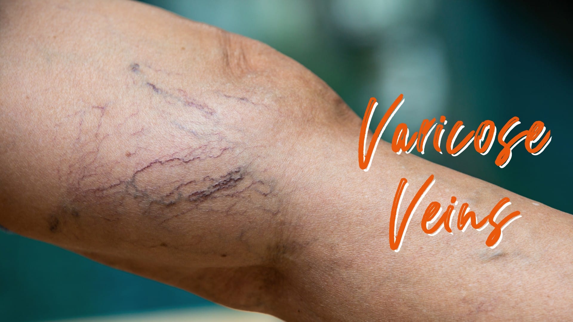 Varicose Veins