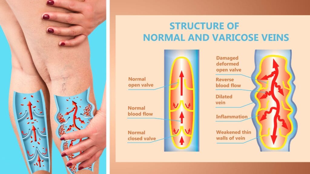 Varicose structure