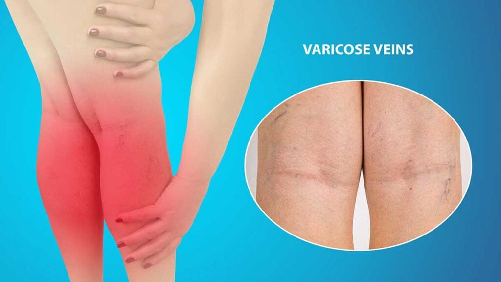 What Are Varicose Veins? ​