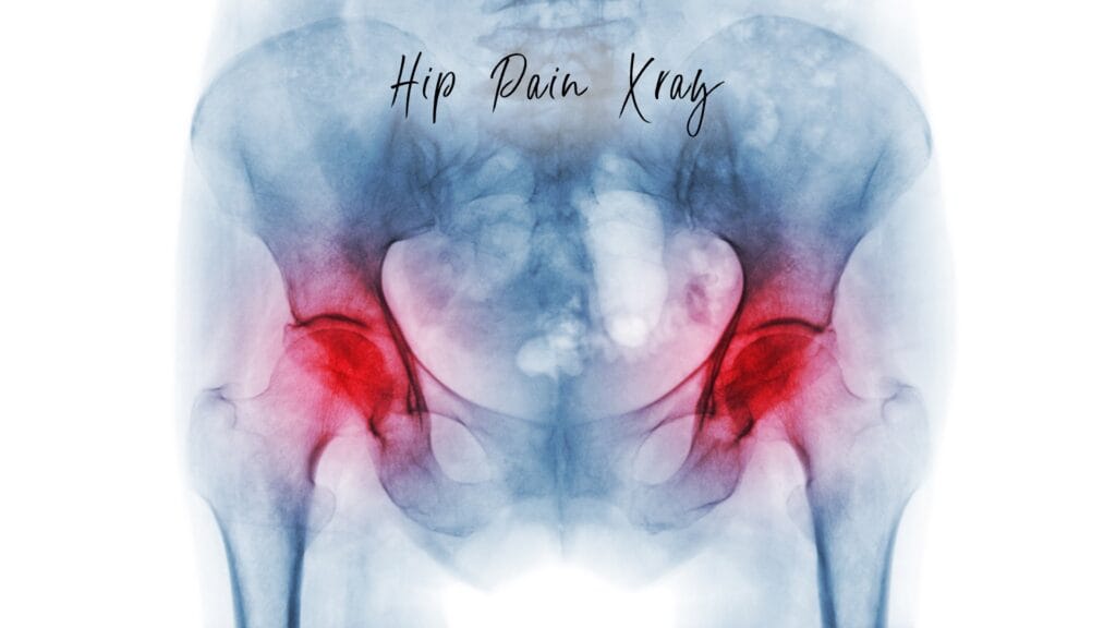 hip pain xray