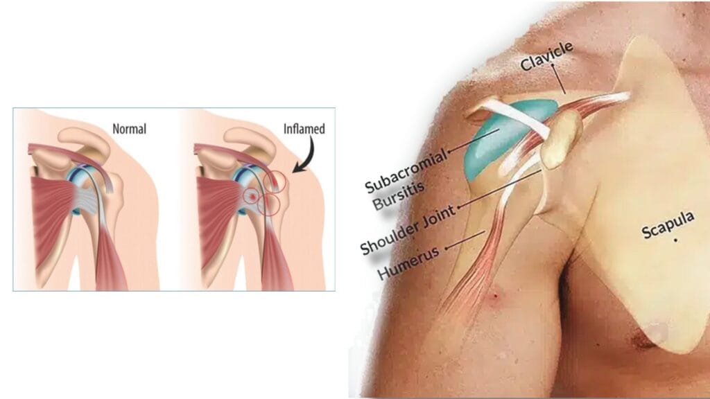 anatomy Subacromial Bursitis